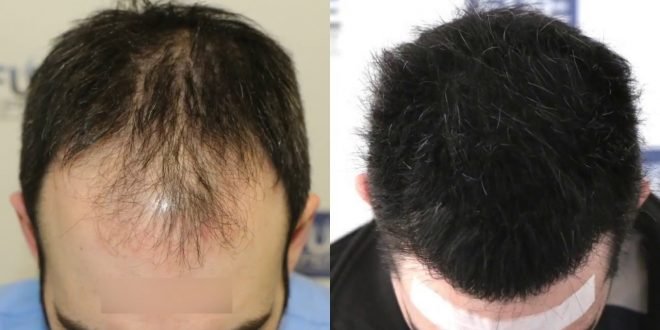 زراعة الشعر بتقنية الاقتطاف