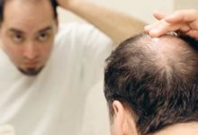 علاج تساقط الشعر عند الرجال