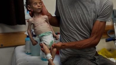 سوء التغذية في غزة